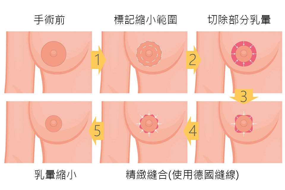 乳暈縮小手術