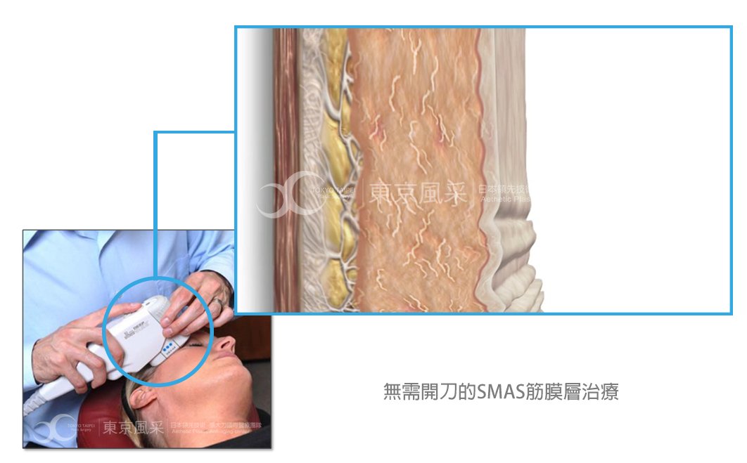 極線音波拉皮特色
