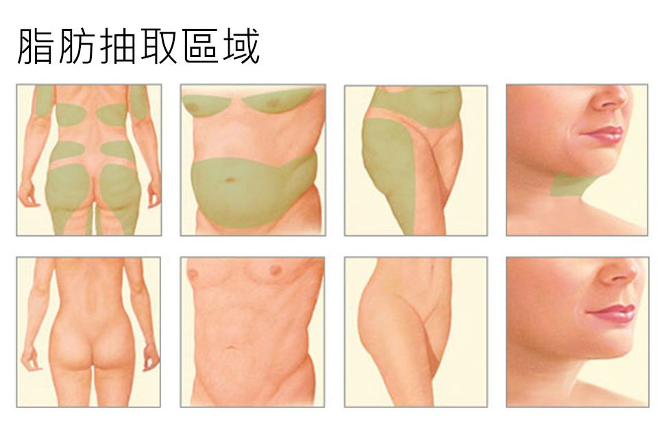 脂肪抽取區域
