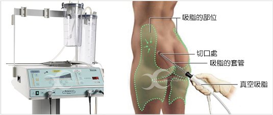 複合式抽脂拉提