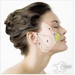 複合式雙層拉皮圖