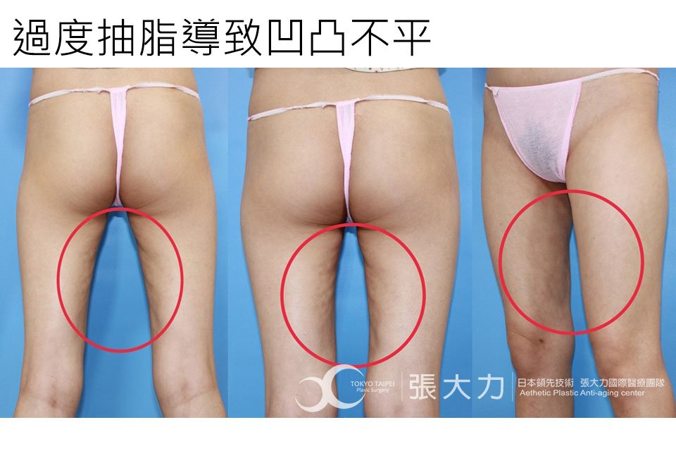 過度抽脂導致凹凸不平