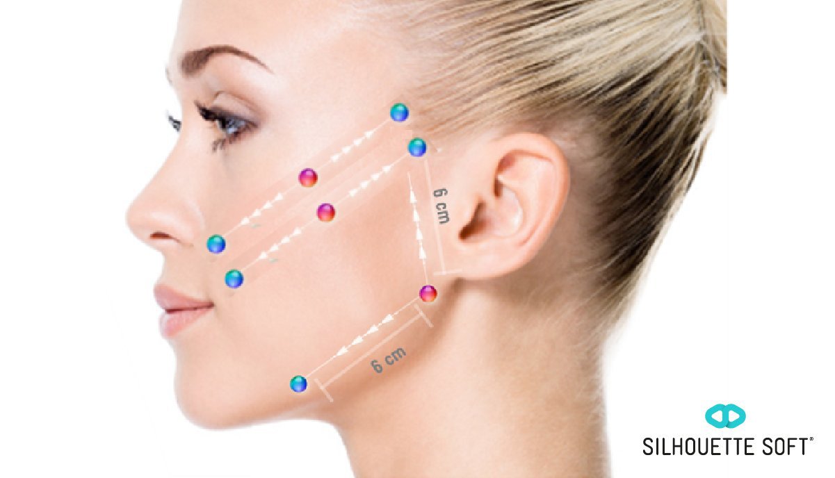 非手術性臉部拉提療程