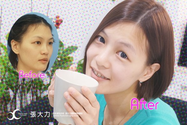 二段式隆鼻一舉兩得！挺翹又改善鼻中隔彎曲