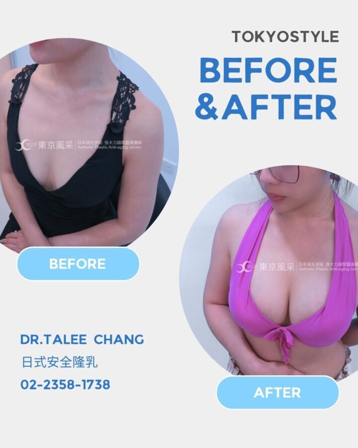 日式5D隆乳案例｜Helen的隆乳手術全紀錄＋術後恢復心得分享