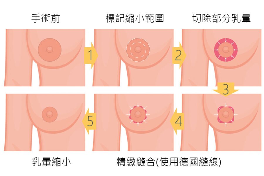 乳暈縮小