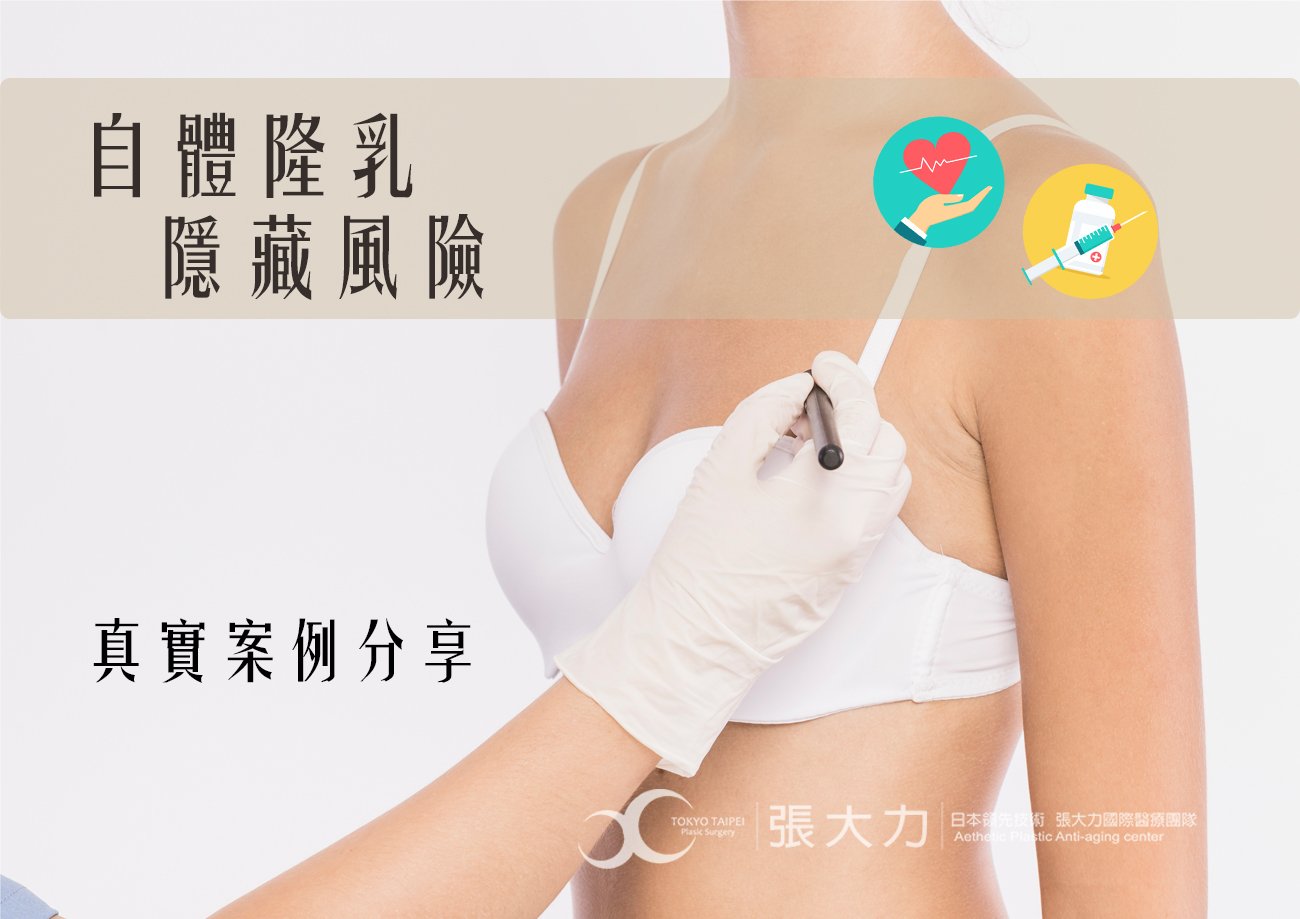 自體脂肪隆乳後悔了! 再次隆乳造就傾心美胸