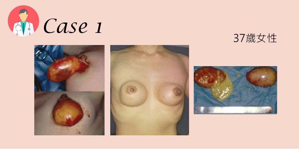 自體脂肪隆乳手術