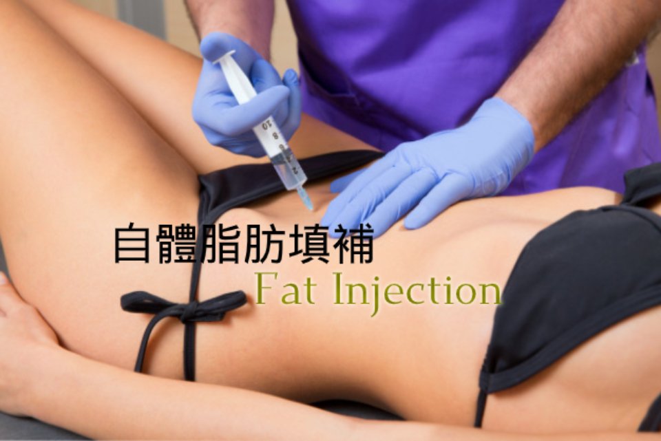 自體脂肪填補雕塑